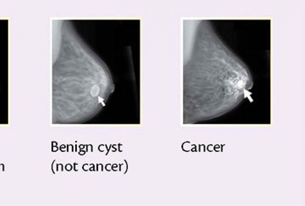 Mammogram nature - https://github.com/Diptoray/breast-cancer-mammography - student project