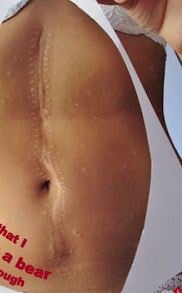 Lose enough weight to show off my AWESOME scar! - student project