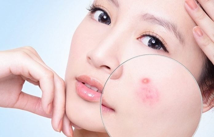 Top 9 thuốc, kem, gel trị sẹo tốt nhất trả lại sự tự tin cho bạn - student project