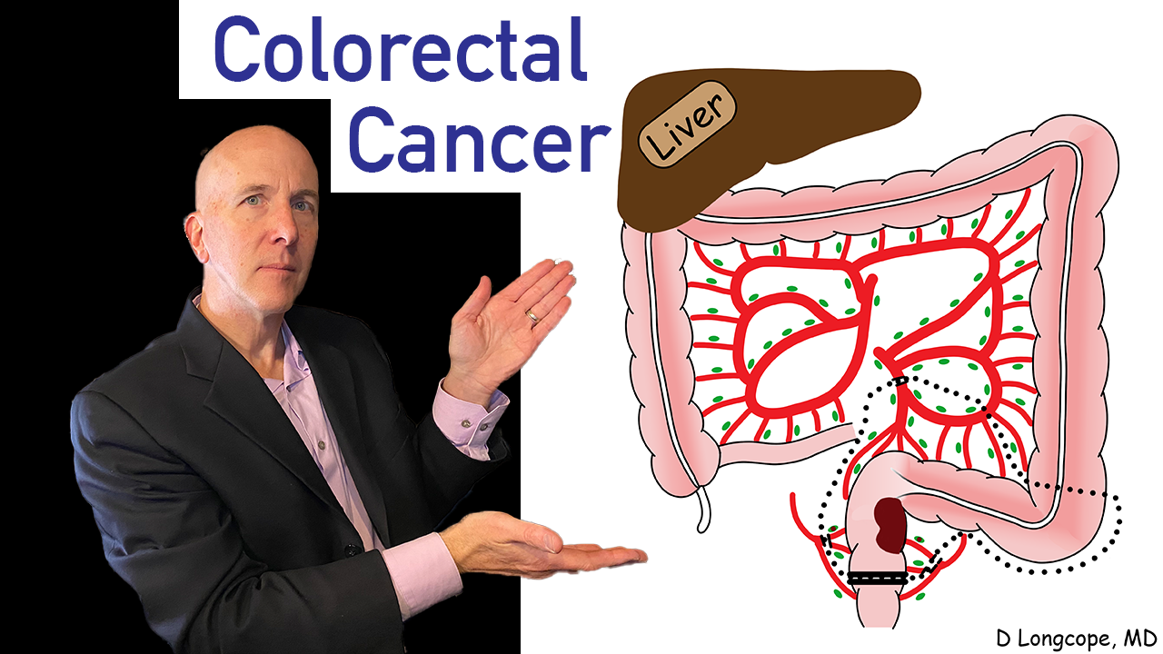 Colorectal Cancer - student project
