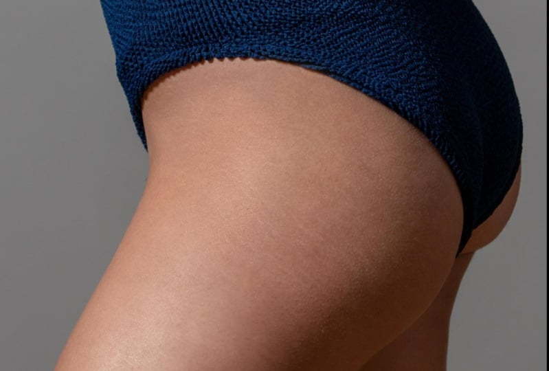 Stretch marks removal
